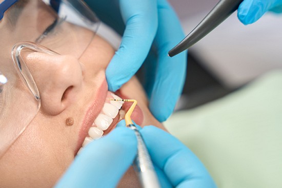 4 Benefits of Dental Crowns image