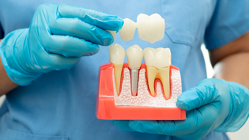 Implant Supported Bridge