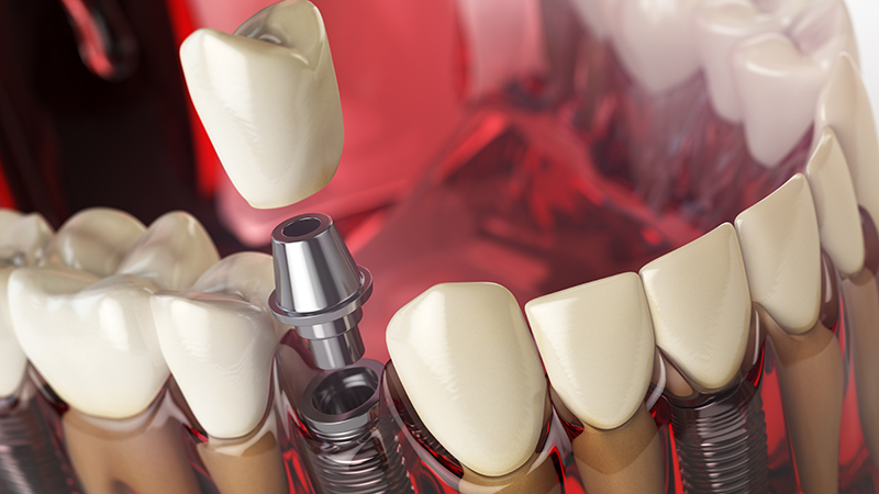 Muliple Implants