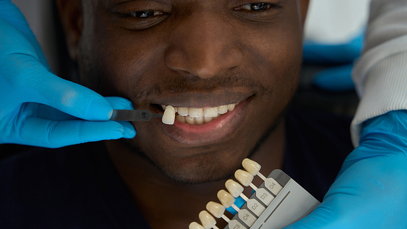 Selecting Veneers