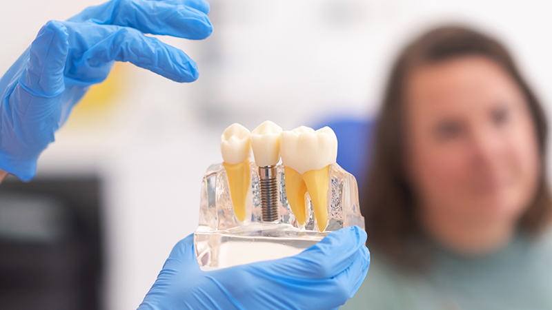 Implant Supported Crown