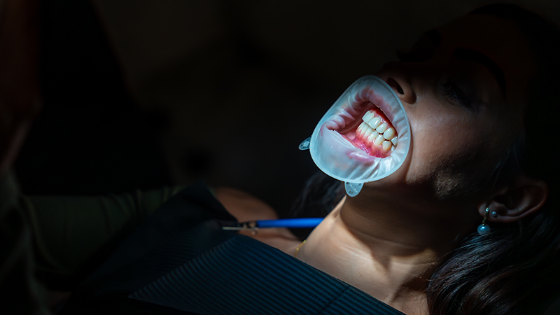 Teeth Whitening