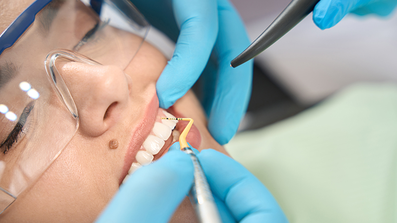 4 Benefits of Dental Crowns