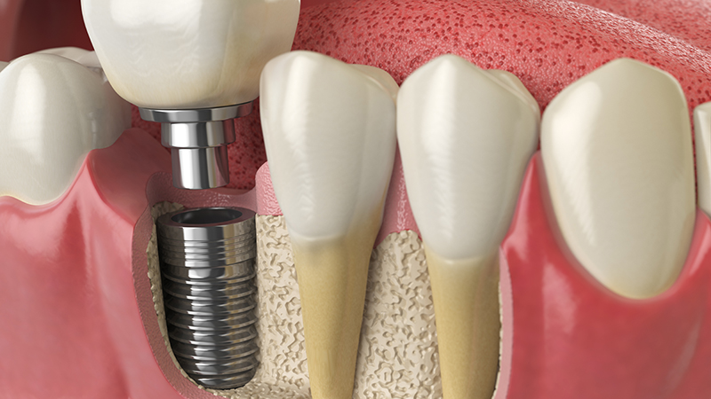 Dental Implants image