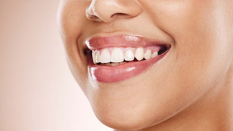 In-Office vs. Take-Home Teeth Whitening